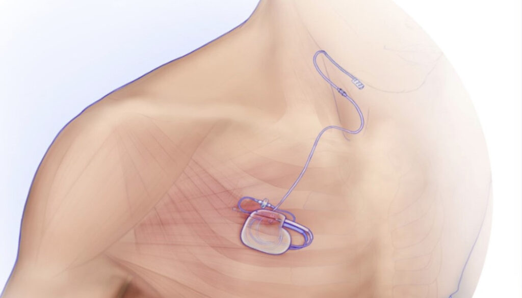 What Are Hypoglossal Nerve Implants?