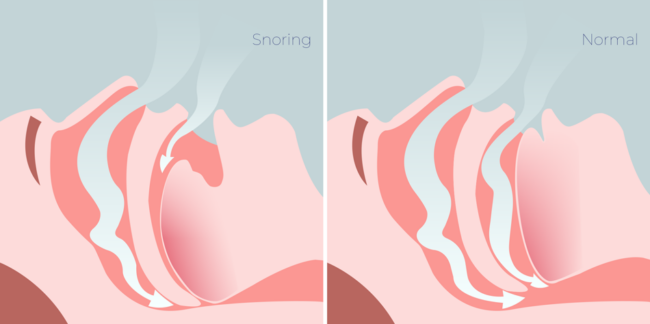 What Causes Snoring? | Snoring and Sleep Clinic