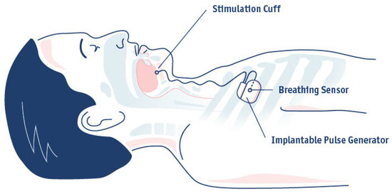 What Is a Hypoglossal Nerve Implant?